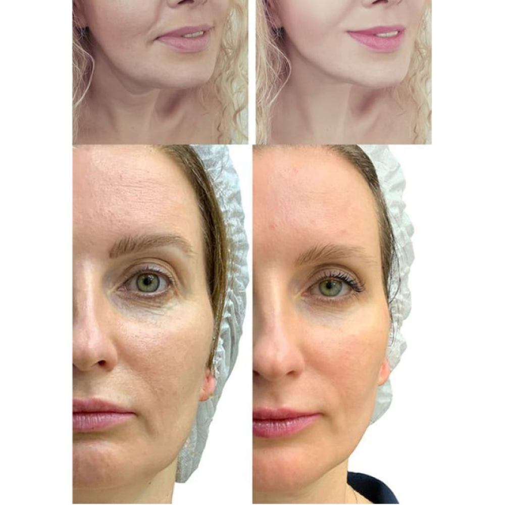 Mikroprądowy masażer do liftingu twarzy MEDICA+ RF Skin Lifting 7.0 Pink – EMS, LED (Japonia)