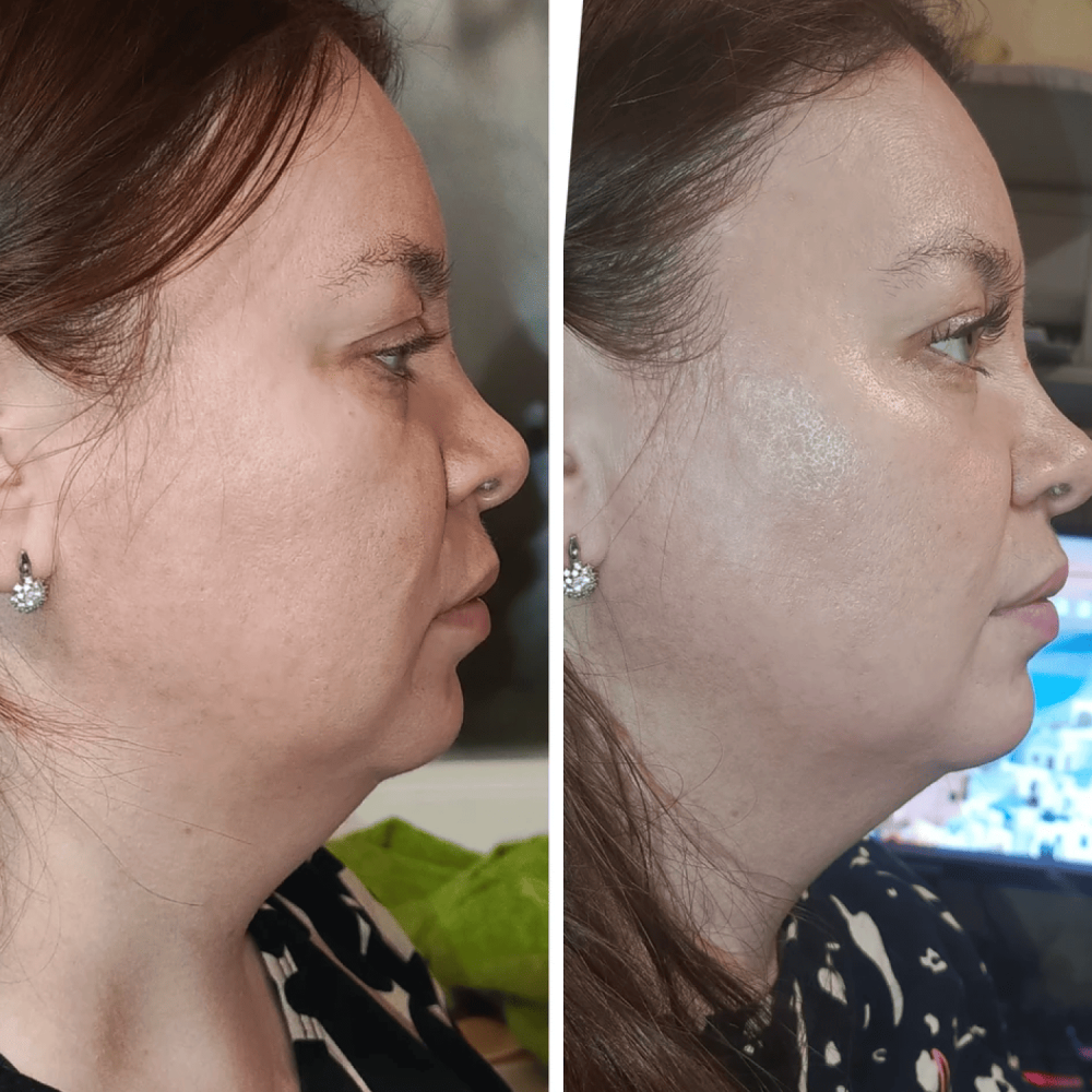 Mikroprądowy masażer do liftingu twarzy MEDICA+ RF Skin Lifting 7.0 Pink – EMS, LED (Japonia)