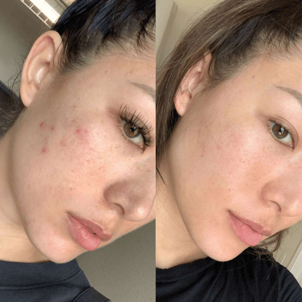 Aparat Darsonval MEDICA+ Lux Darsoline 8.0 (Japonia)